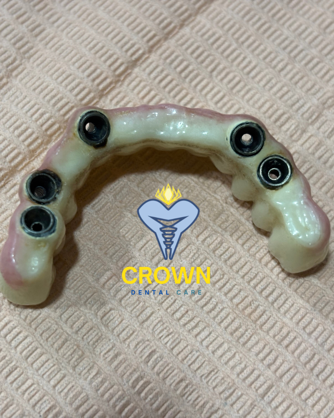 DMLS multi-unit implant supported prosthesis